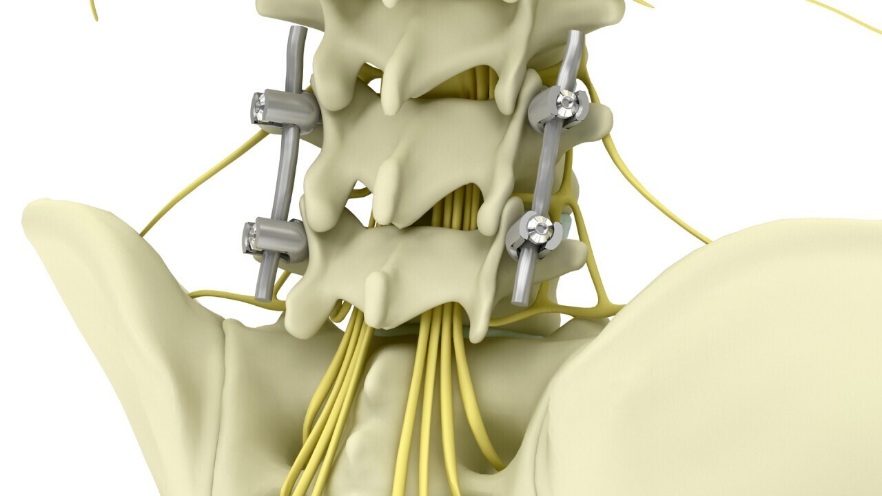 DN Meditech - Spinal surgery - Ti6Al4V-ELI