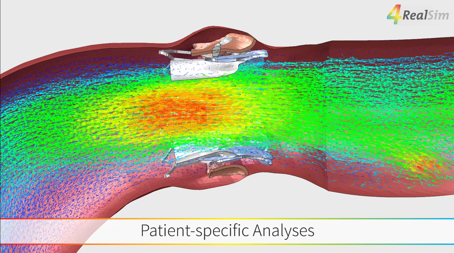 Medizinische Querschnittssimulation des Blutflusses durch eine gestentete Arterie, mit farbigen Flussmustern (grün, gelb, rot) und dem Text Patientenspezifische Analysen am unteren Rand. Das 4RealSim-Logo befindet sich oben rechts.