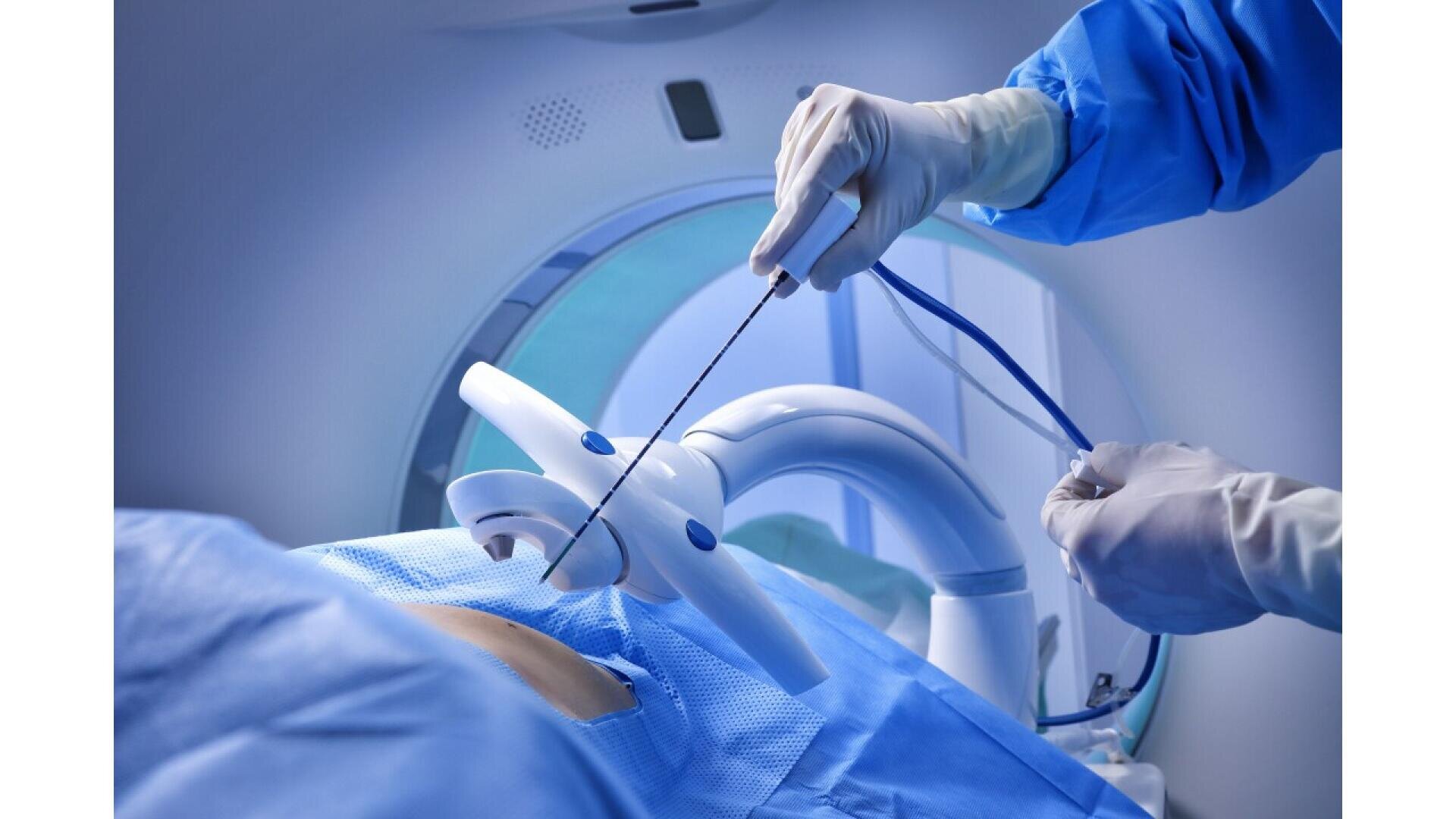 Ein medizinischer Fachmann mit OP-Handschuhen bedient hochmoderne Geräte in der Nähe des bedeckten Bauchbereichs eines Patienten und führt in einer sterilen, hochtechnologischen medizinischen Umgebung einen minimalinvasiven Eingriff durch.