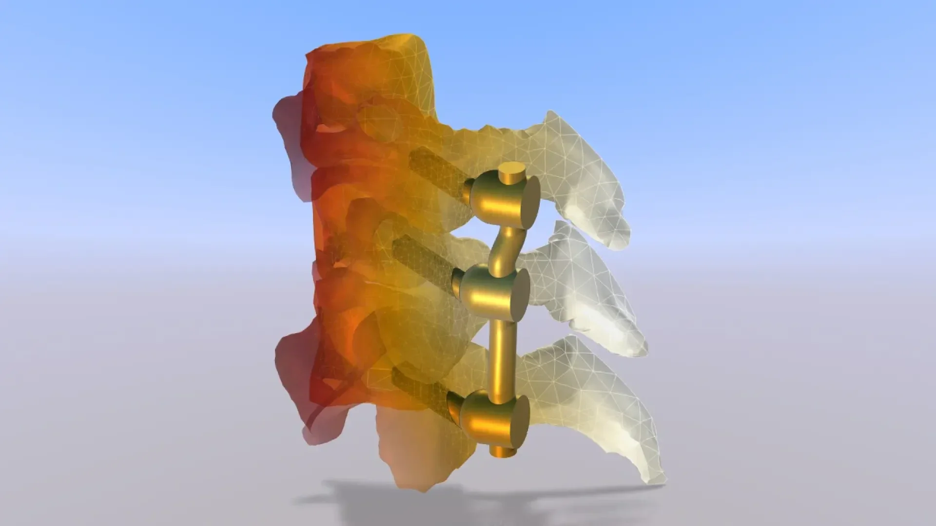 3D-gerendertes Bild von drei menschlichen Wirbeln, teilweise transparent, mit goldenen Wirbelsäulenimplantaten, die sie vertikal vor einem blauen Hintergrund mit Farbverlauf verbinden. Die linke Seite der Wirbel ist in orangefarbenen und roten Tönen schattiert.