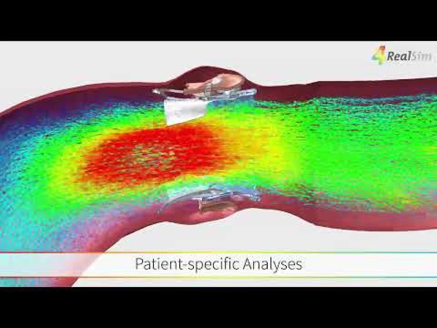 Ein farbkodiertes medizinisches Simulationsbild zeigt die Intensität des Blutflusses um einen Stent in einer Arterie, wobei Rot für Bereiche mit hohem Fluss und Grün/Blau für Bereiche mit geringerem Fluss steht. Der Text lautet "Patientenspezifische Analysen".