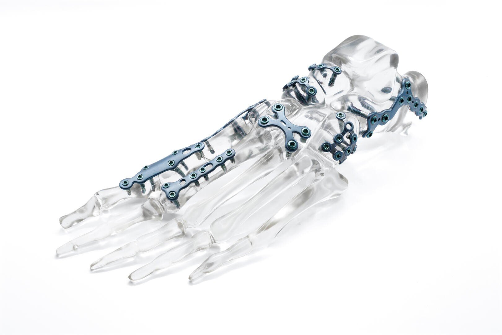 Ein transparentes Modell eines menschlichen Fußes, an dem metallische orthopädische Platten und Schrauben angebracht sind, um chirurgische Fixierungstechniken für Knochen zu demonstrieren.