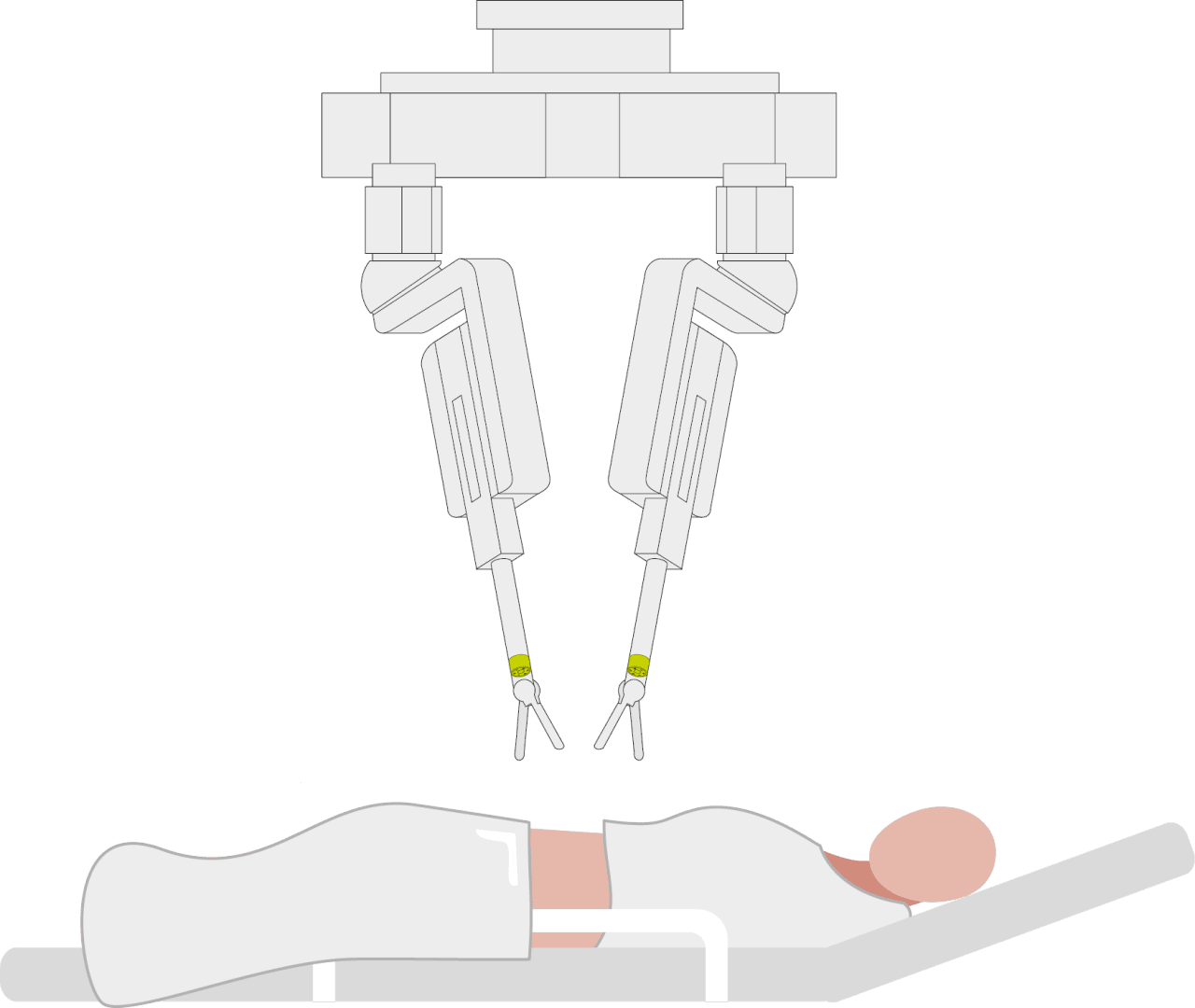 Illustration of a patient lying on an operating table with a robotic surgical system above it. Two mechanical arms are positioned above the patients abdomen, suggesting robotic-assisted surgery.