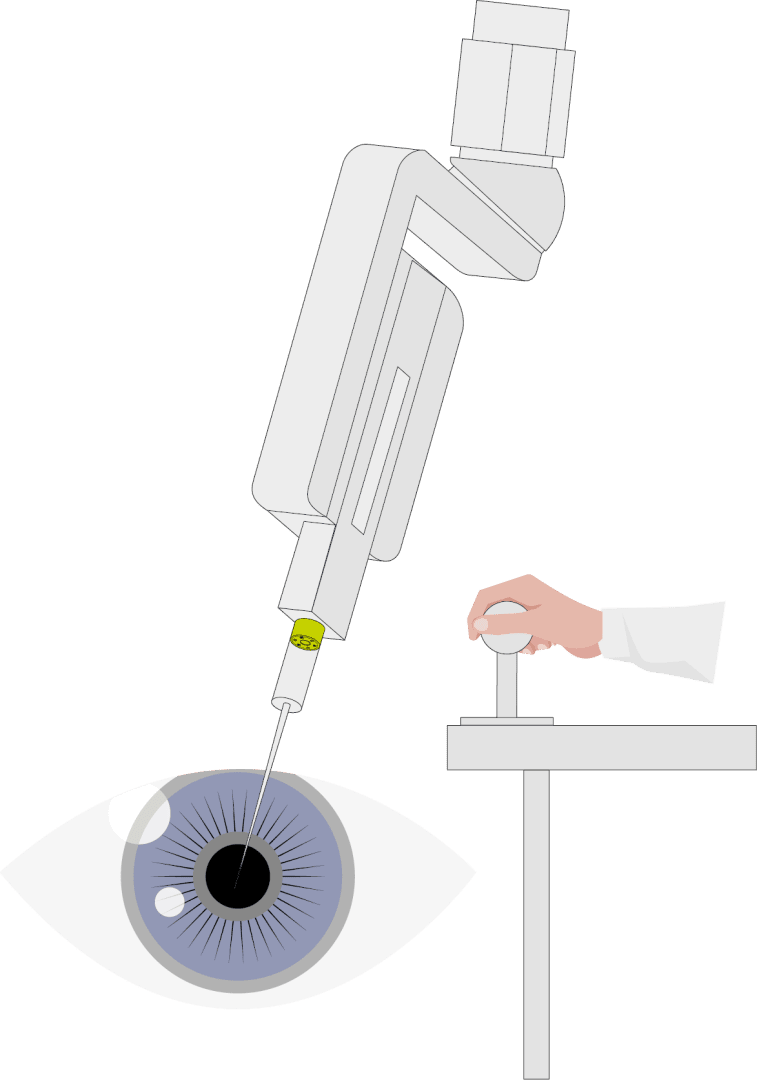 Illustration: A robotic arm inserts a needle into an eye while a hand operates the robot controller from a nearby console.