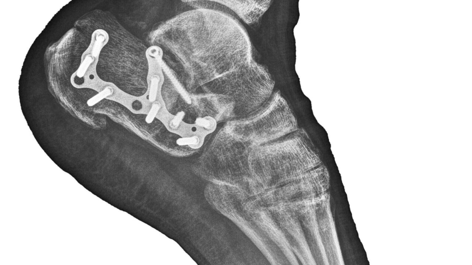 X-ray of a foot showing metal plates and screws fixed to the heel bone, indicating surgical repair of a fracture or injury. The bones and surgical hardware are clearly visible.