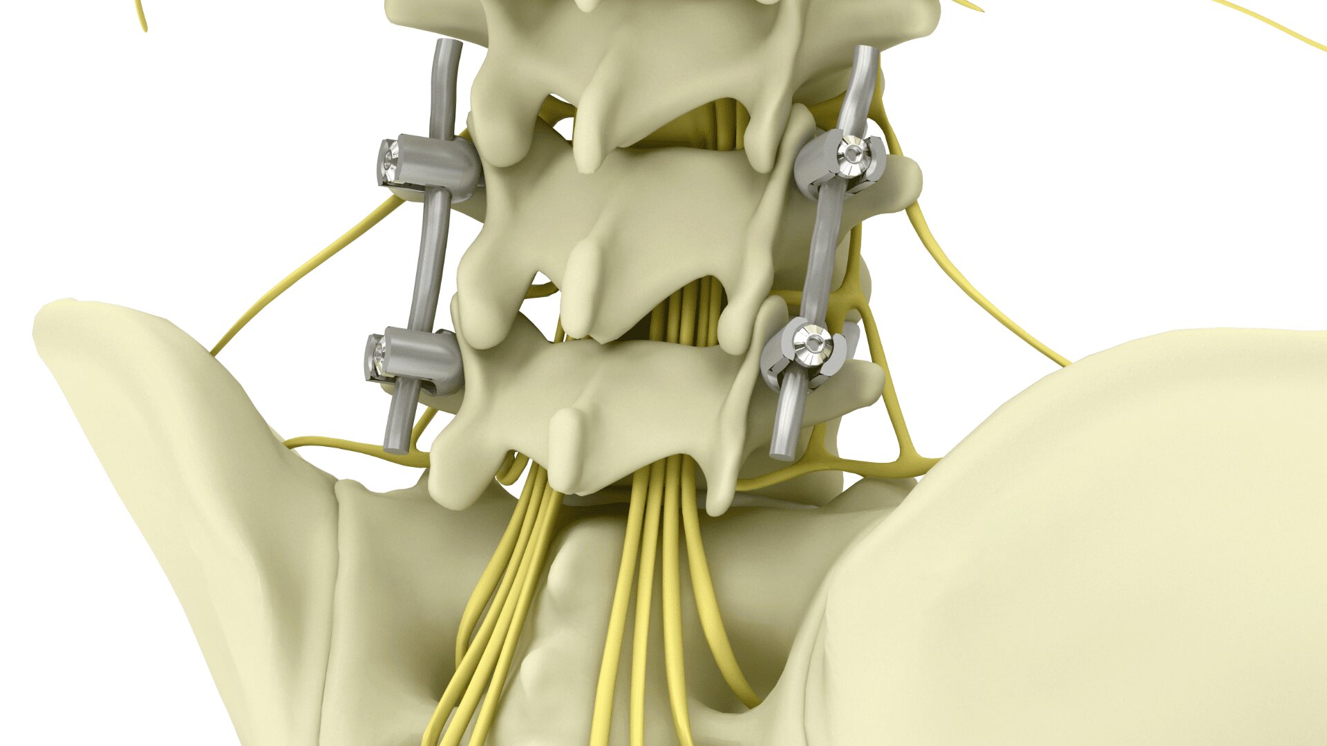 Medizinische 3D-Illustration der Halswirbelsäule mit Wirbeln mit Metallstäben und Schrauben, die auf eine Wirbelsäulenfusion hinweisen, mit gelben Nerven, die von der Wirbelsäule ausgehen.